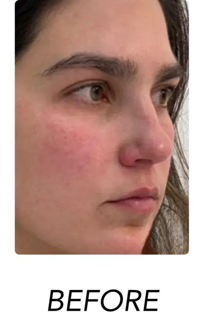 Before Treatment